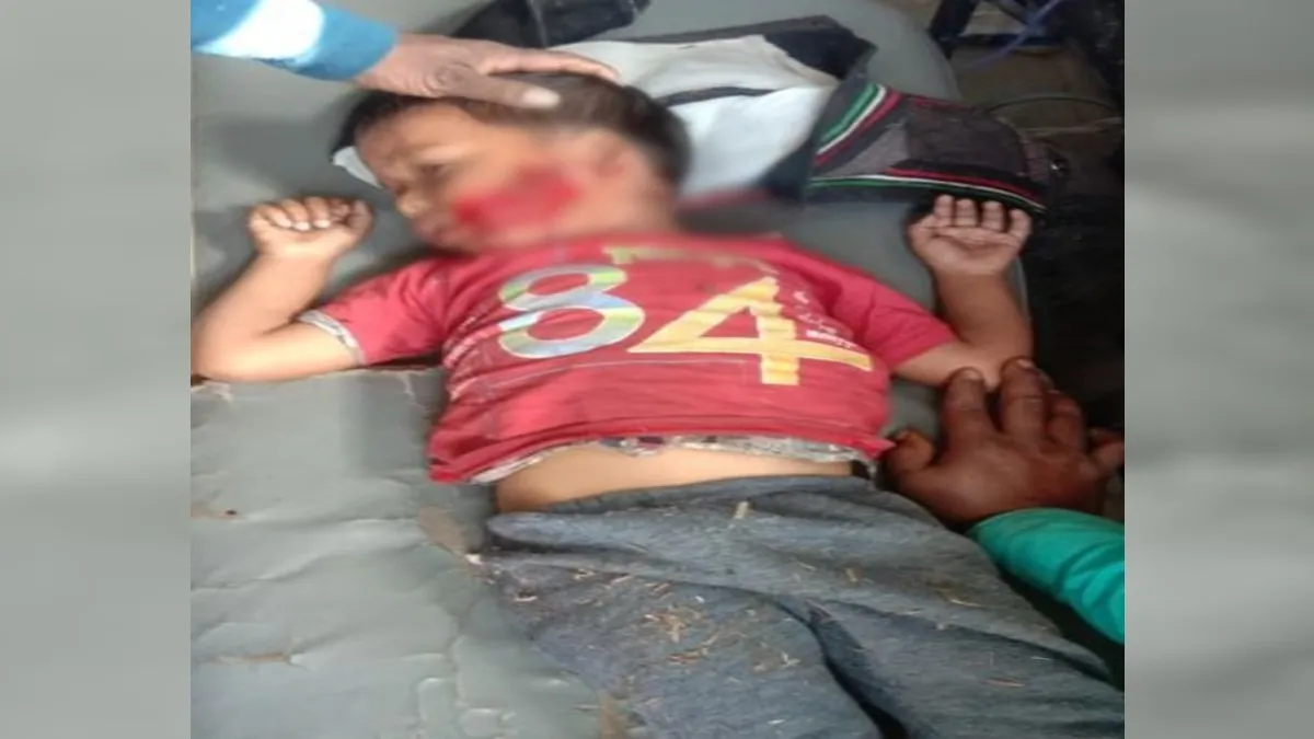 बरेली: कुत्ते ने मासूम बच्चे पर किया हमला, बुरी तरह नोच डाला मुंह