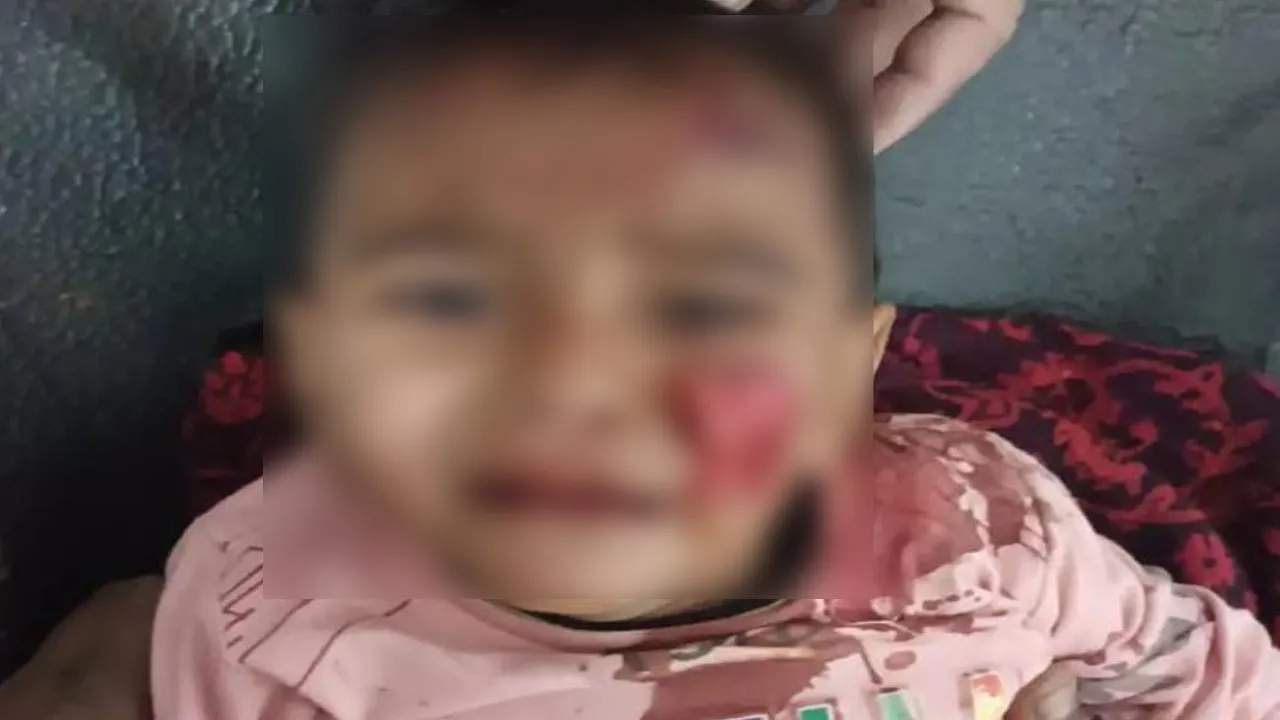 मुरादाबाद: कुत्तों के झुंड ने मासूम बच्चों पर किया हमला, गंभीर घायल