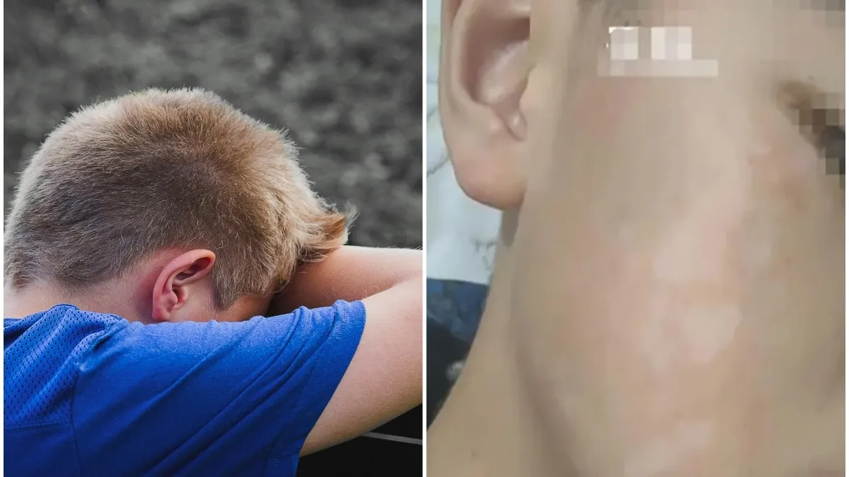 हल्द्वानी: पीटी टीचर ने जड़ा थप्पड़, कक्षा एक के बच्चे का सूजा गाल 