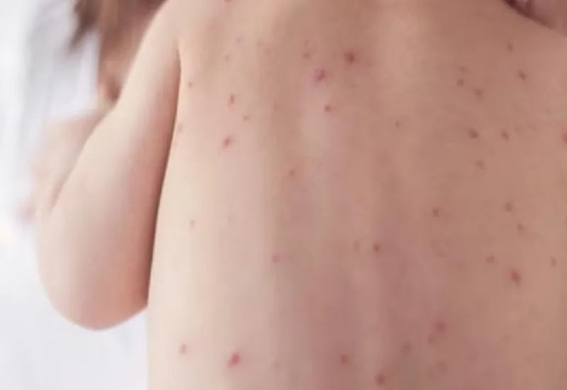 यूरोप में खसरे का सबसे बुरा प्रकोप, WHO ने कहा-उच्च टीकाकरण दरों के बिना कोई स्वास्थ्य सुरक्षा नहीं