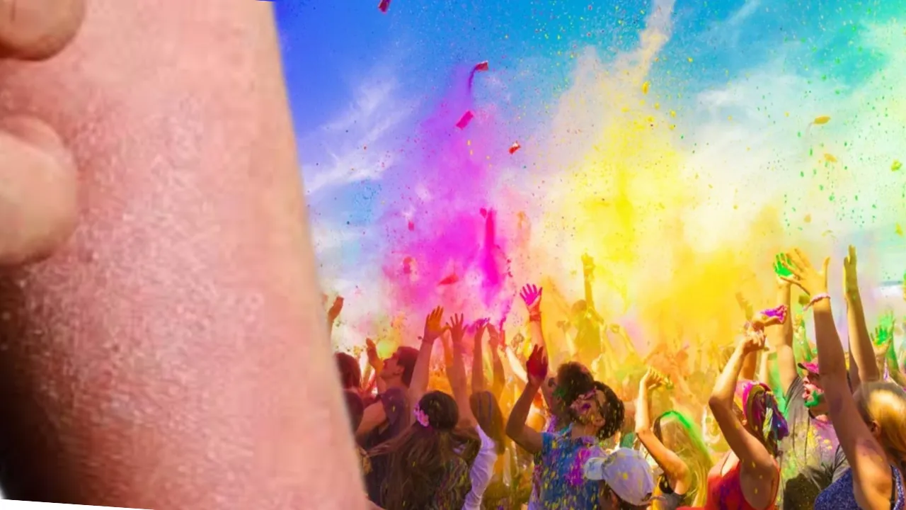 Holi Chemical Colors: केमिकल वाले रंगों से हो सकता है एक्जिमा, जानें कैसे करें बचाव