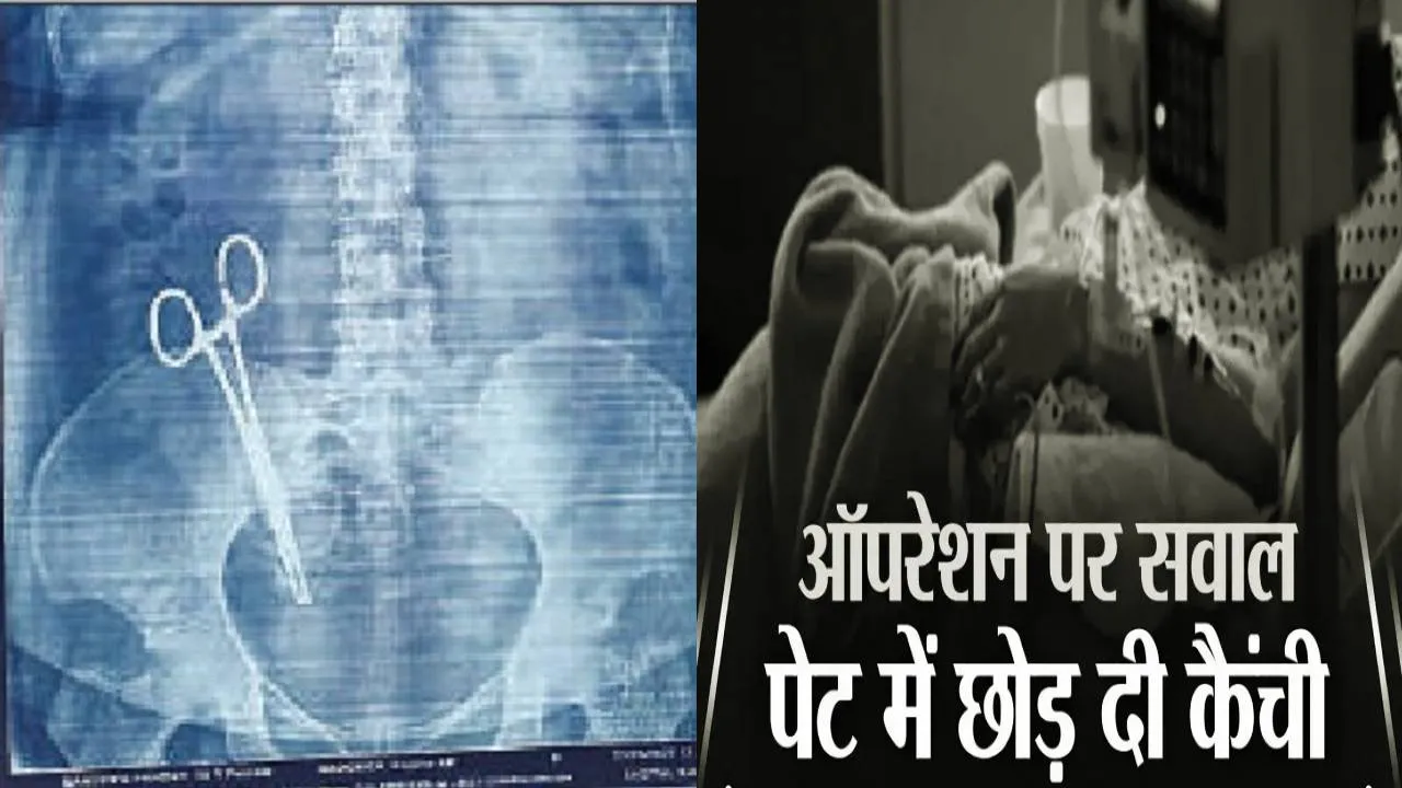 डॉक्टरों की लापरवाही: सर्जरी के बाद महिला के पेट में 17 साल तक पड़ी रही कैंची!
