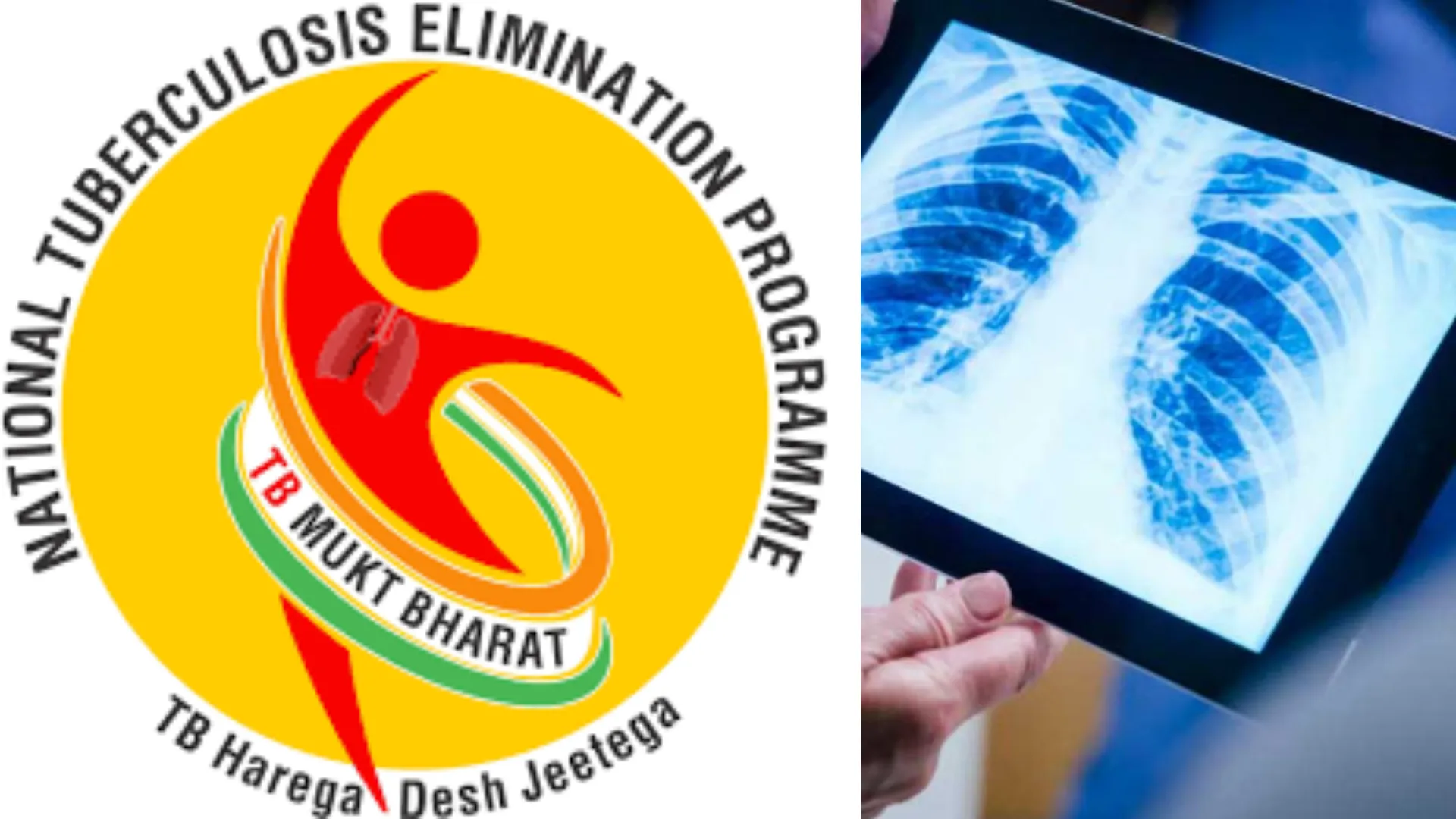 टीबी मुक्त अभियान: स्वास्थ्य विभाग चलाएगा 100 दिनों का अभियान, मरीजों को खोजकर कराया जायेगा इलाज 