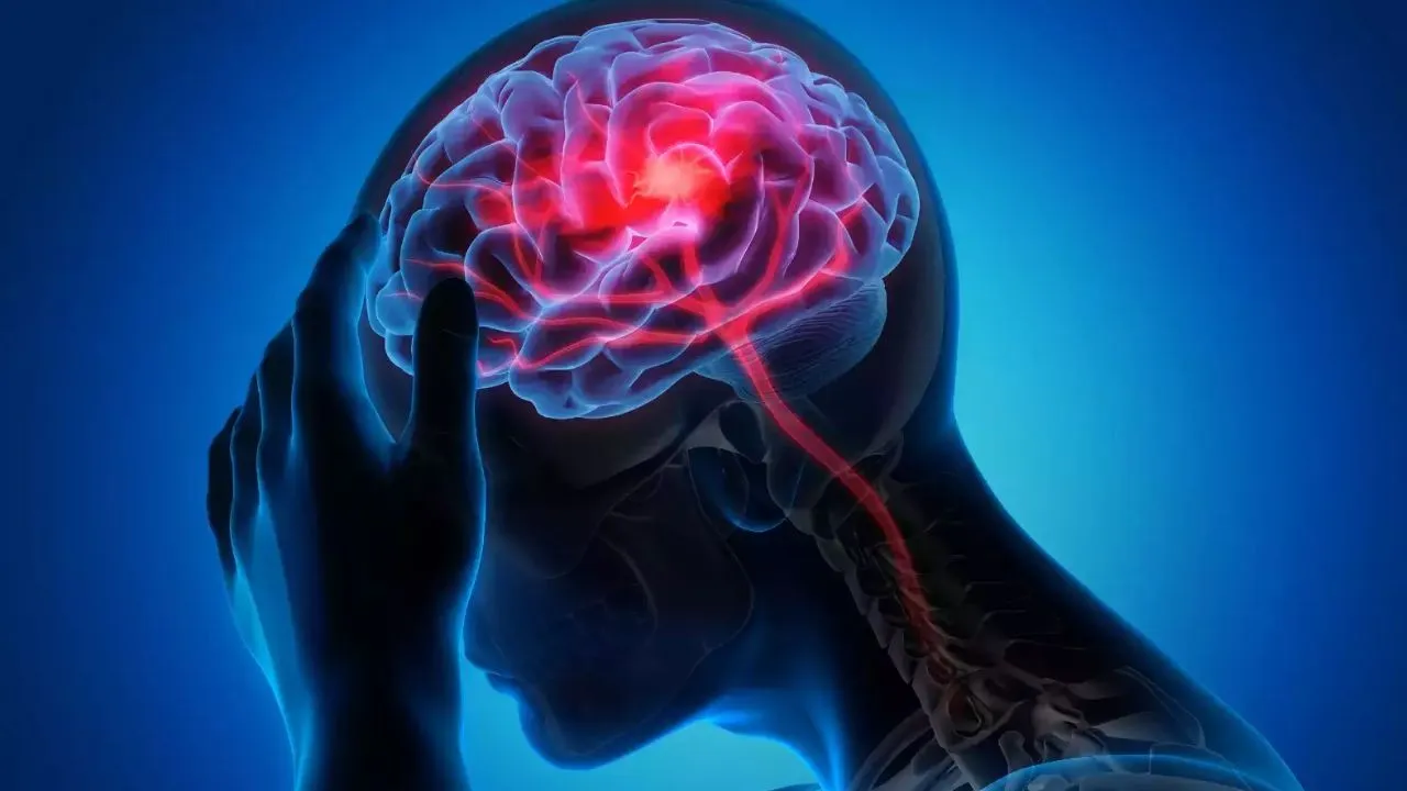 माइग्रेन को नजरअंदाज करने से हो सकता ब्रेन अटैक, कानपुर में डॉक्टर बोले- चाइनीज फूड भी बीमारी के बढ़ने की एक वजह  