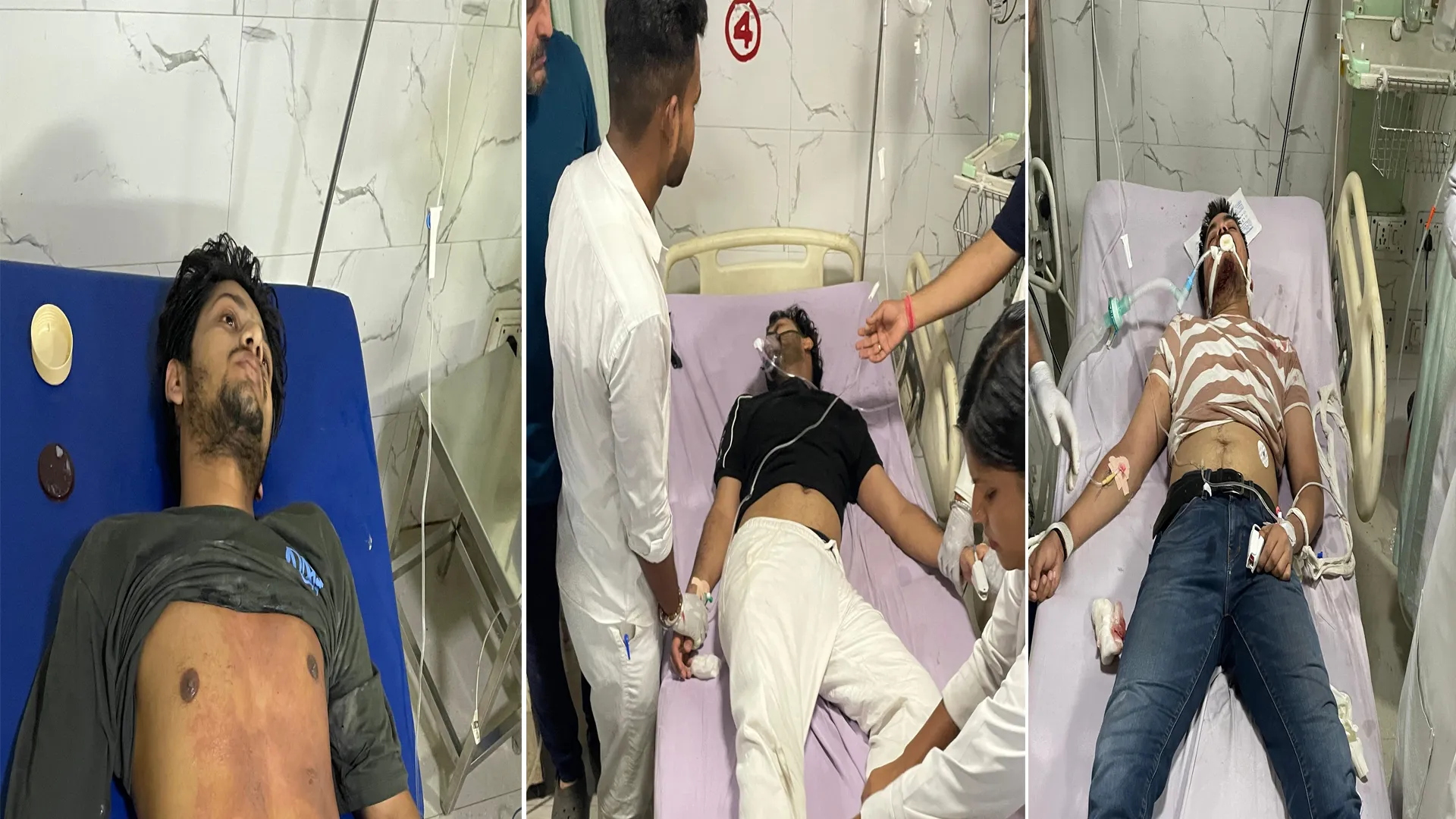 मुरादाबाद: टीएमयू कैंपस में आकाशीय बिजली गिरने से 5 छात्र झुलसे, दो की हालत गंभीर