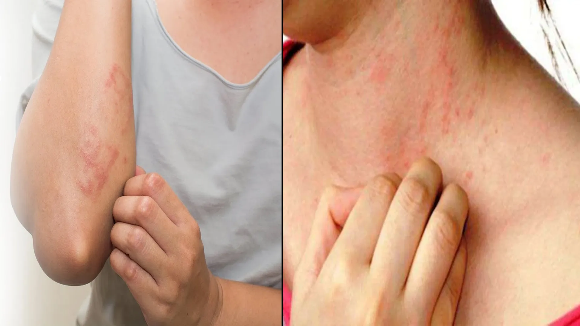 शाहजहांपुर : गर्मी के साथ बढ़ रहे दाद-खाज, खुजली एलर्जी के मरीज