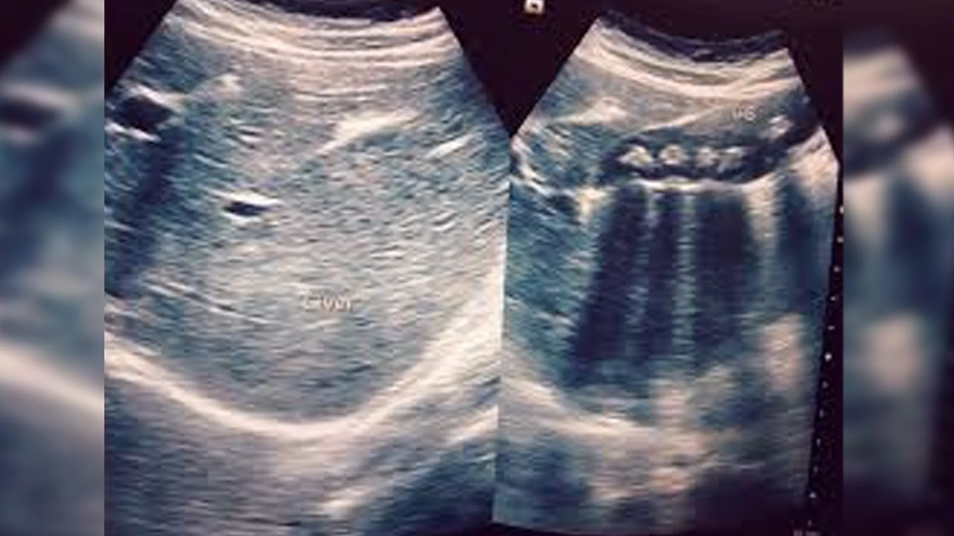 पीलीभीत: मरीज की दो अल्ट्रासाउंड की रिपोर्ट अलग-अलग..एक में बताई पथरी तो दूसरे में सब नॉर्मल...अब होगी जांच