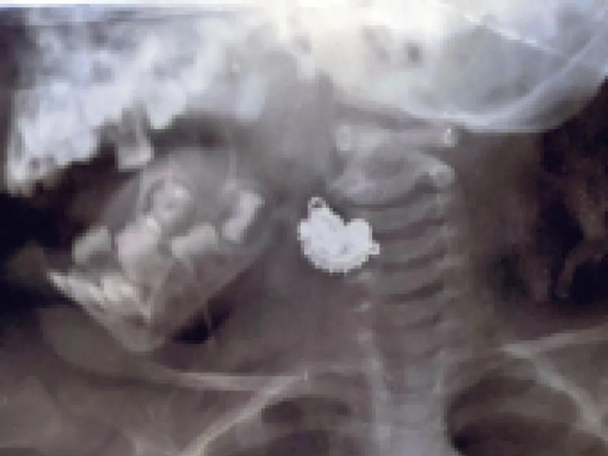 दो साल की बच्ची ने निगला झुमका, डॉक्टरों ने किया सफल ऑपरेशन  