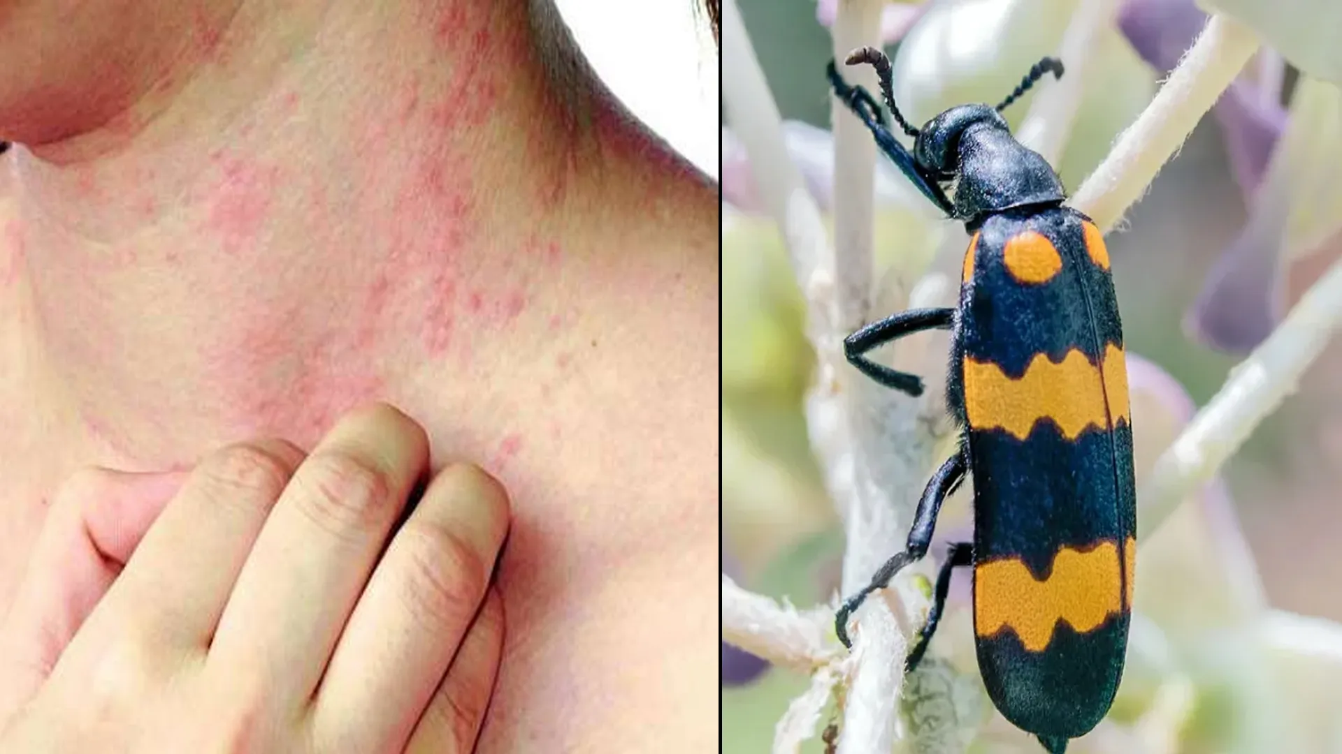 मुरादाबाद : पानी वाले दाने दे रहे दर्द, लोग परेशान