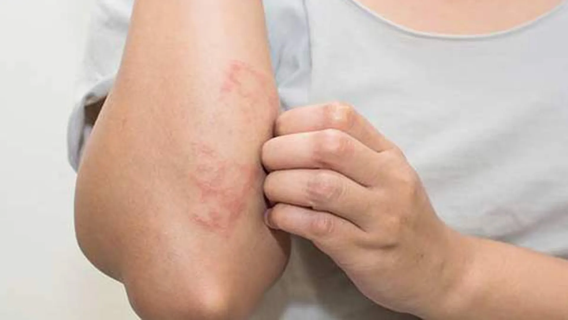 मुरादाबाद : काट रहे कीड़े, लोग हो रहे स्केबीज का शिकार