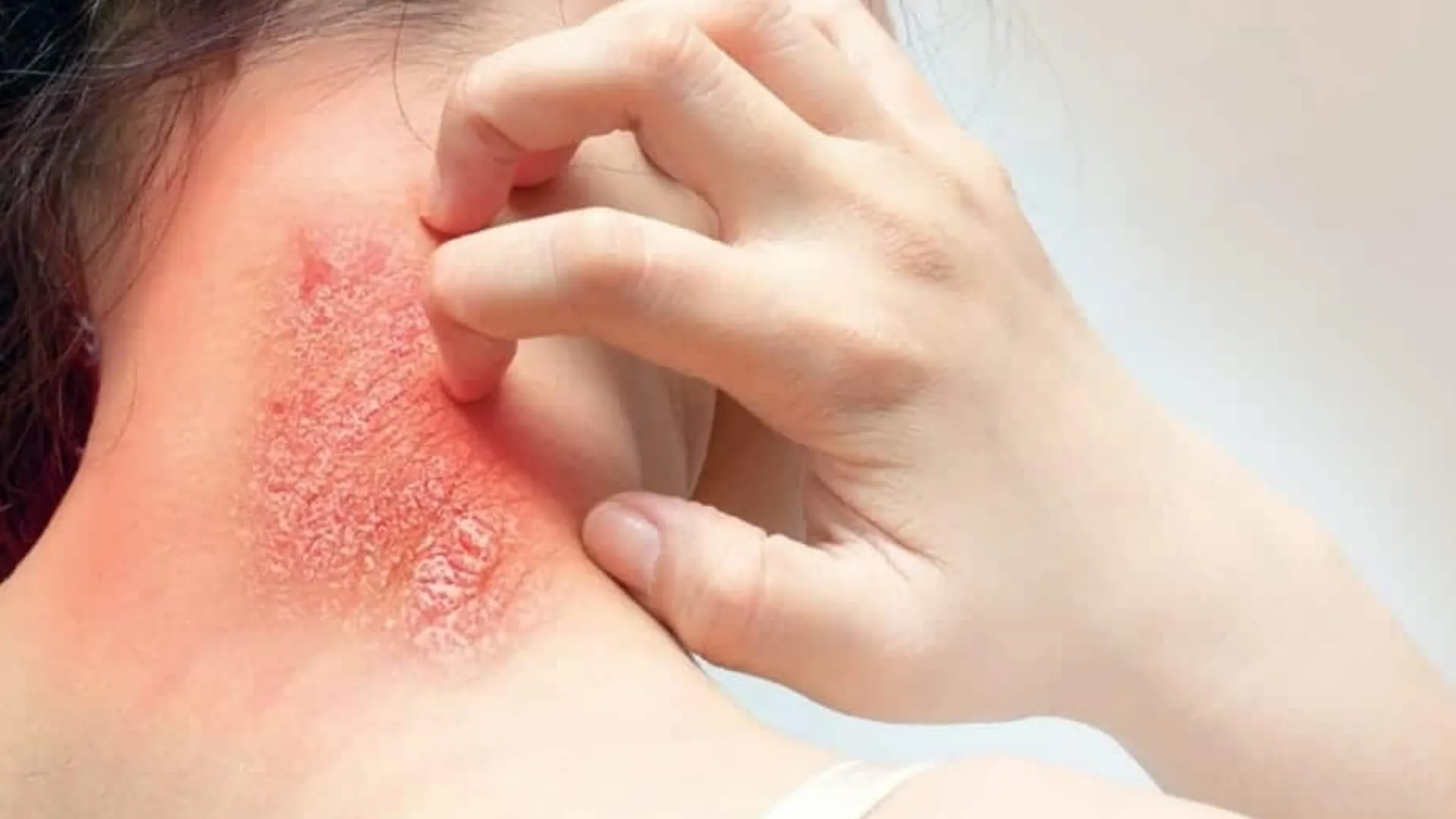 बारिश और उमस से बढ़े फंगल इंफेक्शन के मरीज: इन बातों का रखे खास ख्याल, जानिए बचने के उपाय