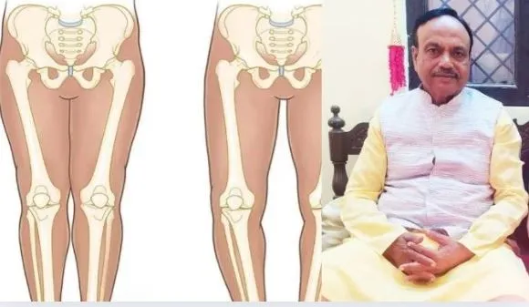 लखनऊ : बच्चों के विकास में जल्दबाजी से बचें, जानिये कितना खतरनाक है वॉकर का इस्तेमाल