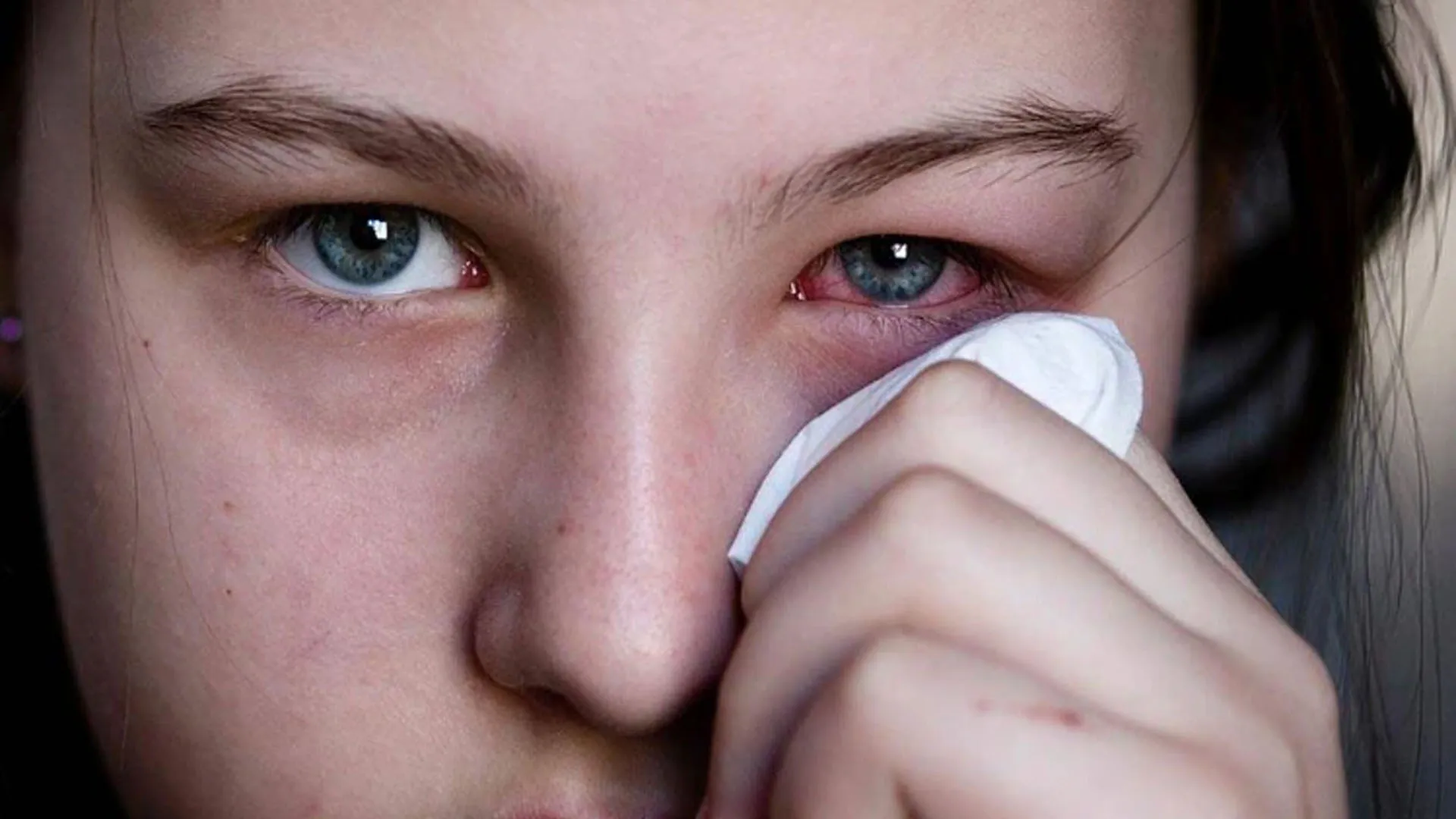 मुरादाबाद: मौसम की मार, लोग हो रहे कंजक्टिवाइटिस के शिकार