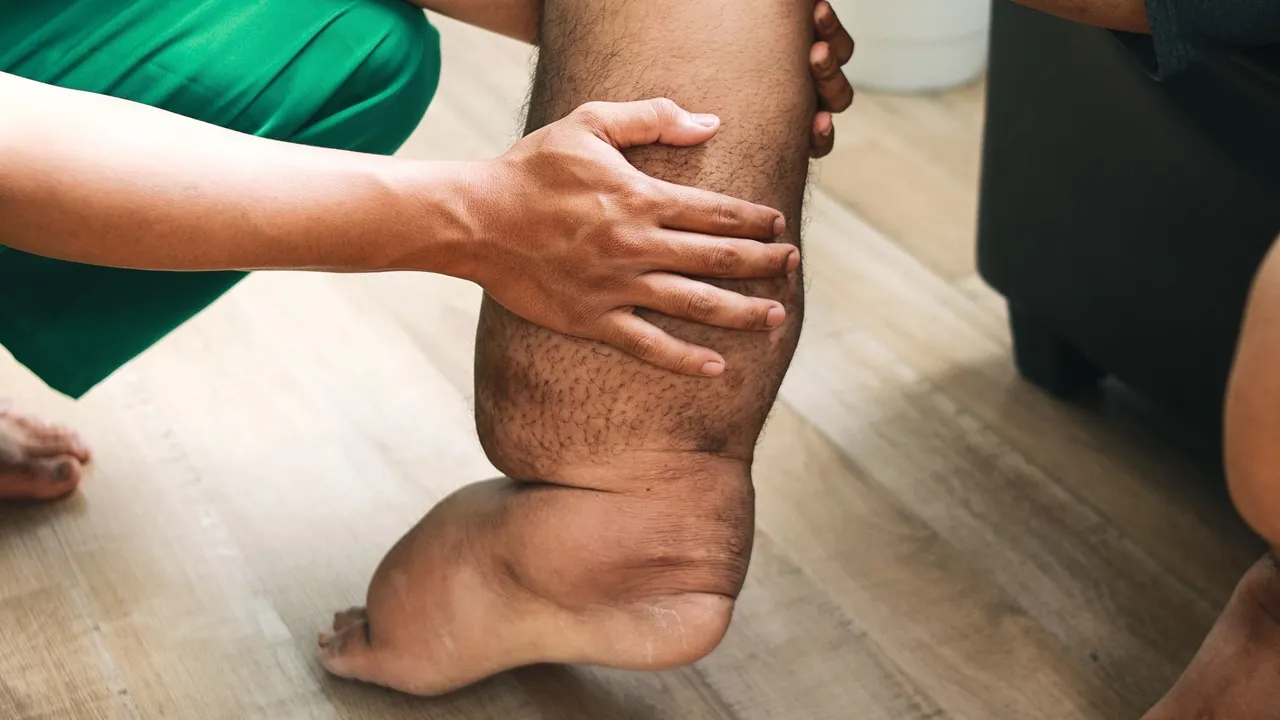 UP के 27 जिलों में फाइलेरिया अभियान शुरू, 195 ब्लॉक में खिलाई जाएगी दवा 