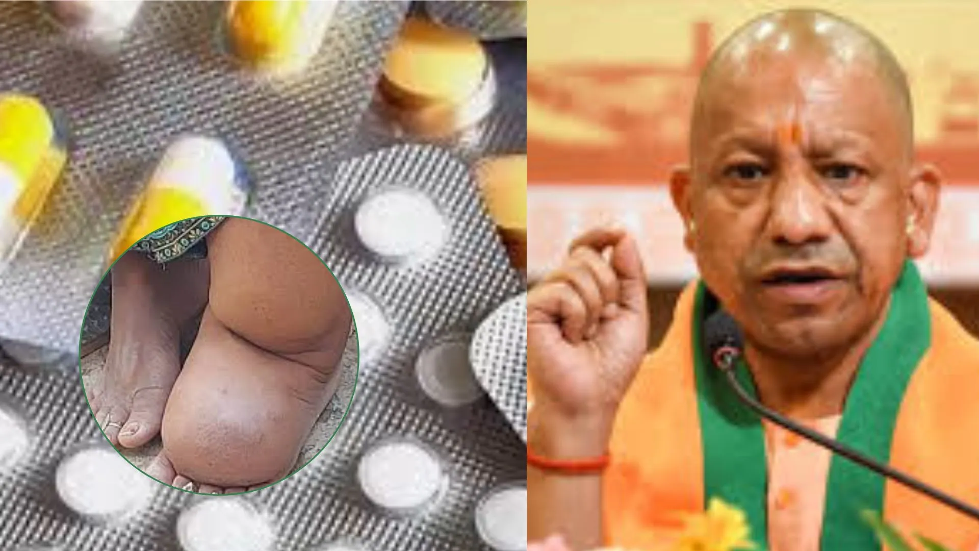 मुख्यमंत्री योगी के निर्देश पर 27 जिलों में फाइलेरिया के खिलाफ अभियान का आगाज, हेल्थ वर्कर घर-घर जाकर खिलाएंगे दवा