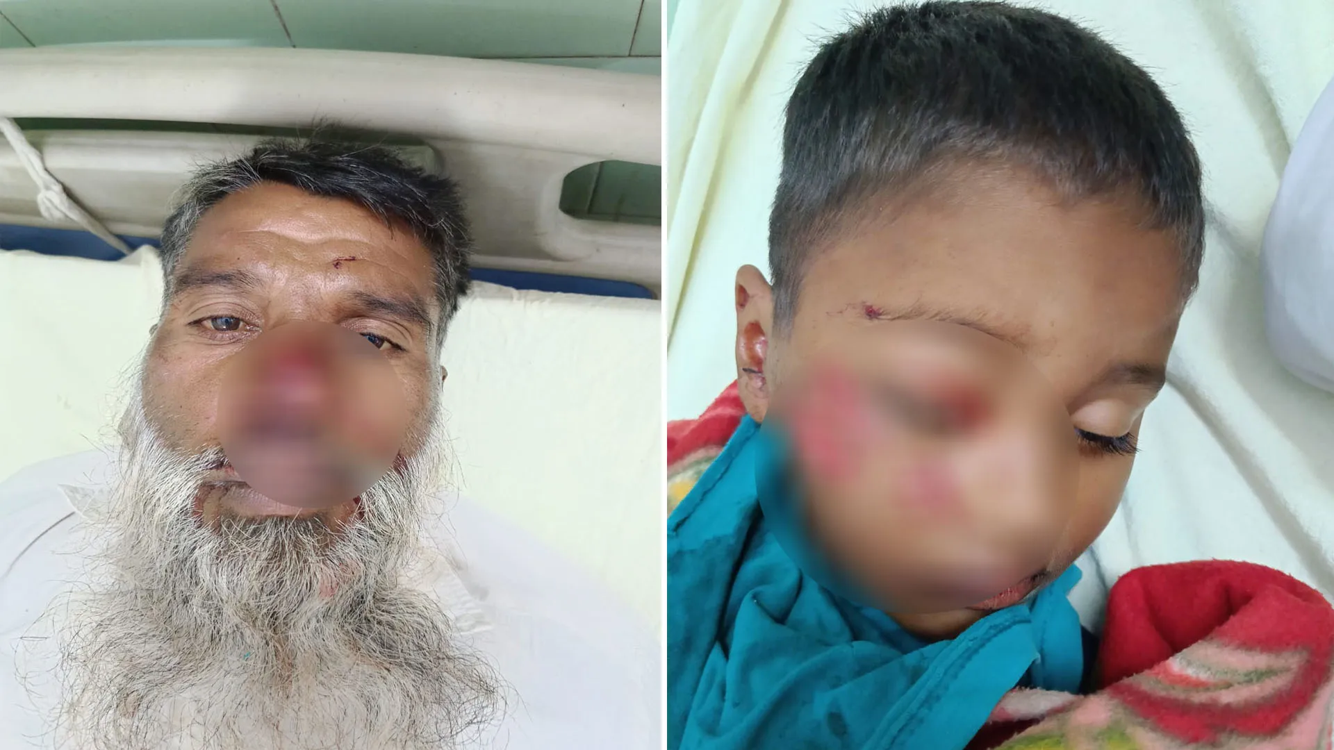 Bareilly: कुत्तों का आतंक बना जानलेवा, हमले में दादा-पोता घायल 