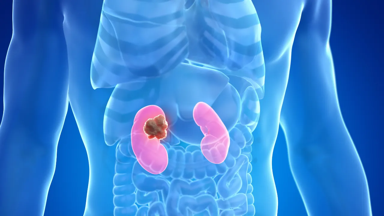 Noida News: किडनी ट्यूमर से बच्चों को बचाने के लिए चाइल्ड PGI कर रहा है रिसर्च