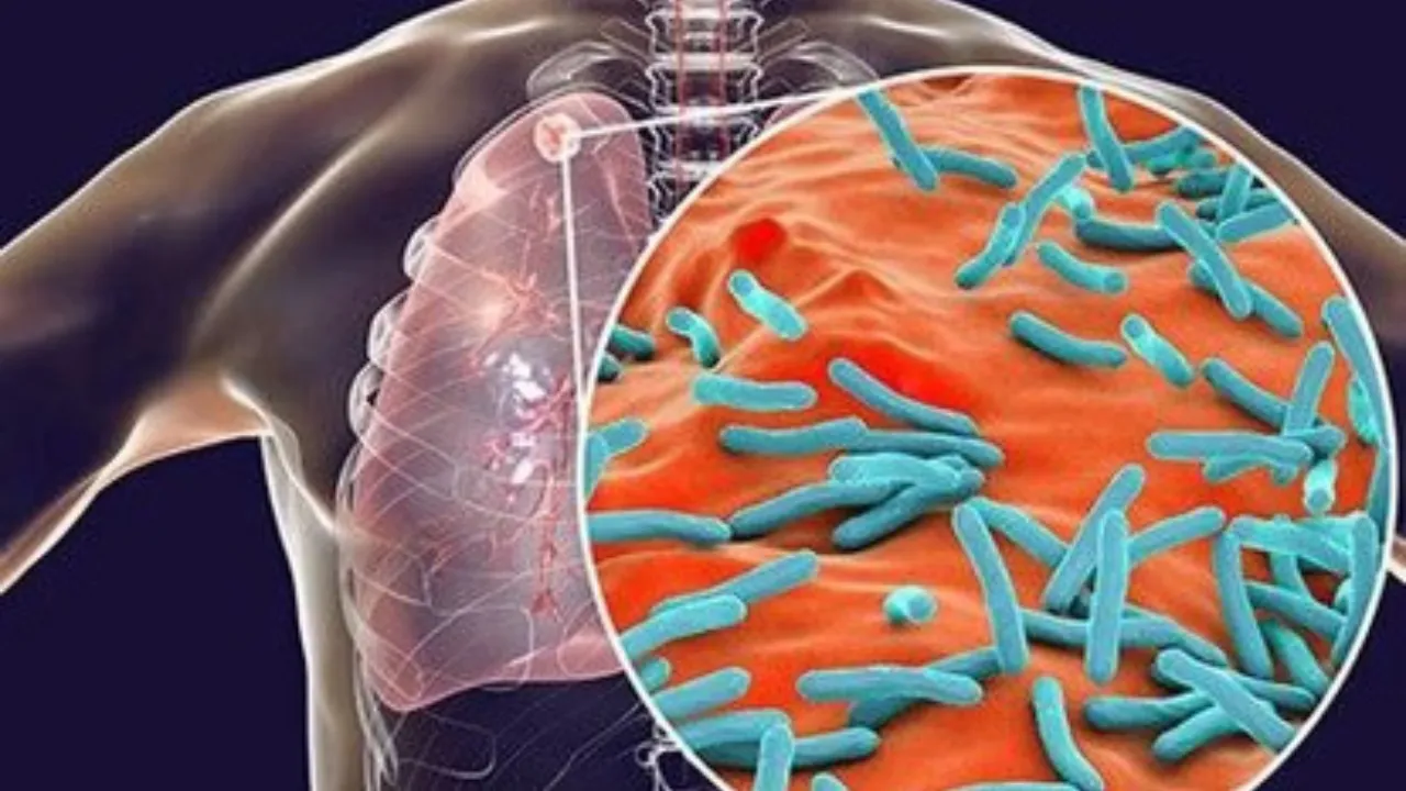 टीबी बीमारी से होने वाली मौतें अब जल्द होंगी कम! नया ‘डिफ्रेंशिएटेड केयर’ मॉडल ला रहा क्रांति