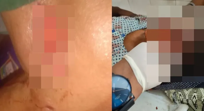 अमेठी : शुकुल बाजार में आवारा कुत्तों के आतंक से ग्रामीणों में दहशत, दो दिनों में 50 लोगों को बनाया निशाना