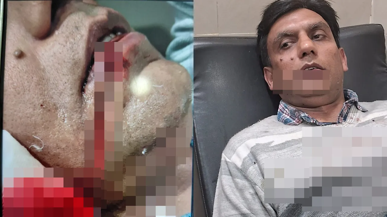 अब चाइनीज मांझे की धार से रिटायर्ड सैन्यकर्मी की चेहरा कटा... राहगीरों ने पहुंचाया अस्पताल, 2017 से प्रतिबंधित है ये मांझा