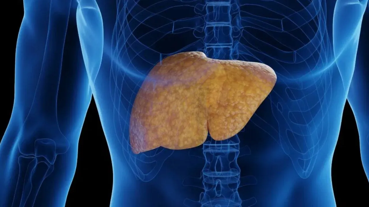 केजीएमयू में पार्टो से तकनीक से इलाज, लिवर सिरोसिस से मरीज को दिया नया जीवन, महिला के पेट में हो रहा था रक्तस्राव