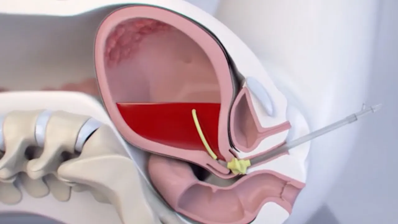 पोस्ट-पार्टम हेमरेज मातृ मृत्यु के प्रमुख कारणों में से एक... देखें क्या बोले एक्सपर्ट