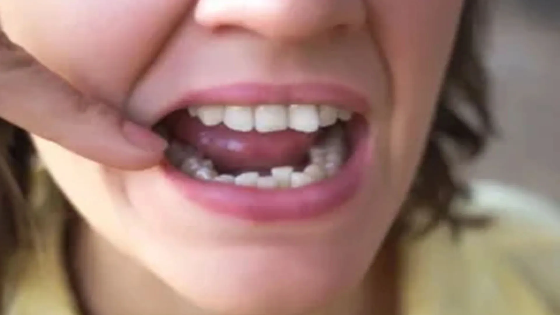 Bareilly : टेढ़े-मेढ़े दांत...सुंदरता ही नहीं कम करते, चबाने और बोलने में भी होती है दिक्कत