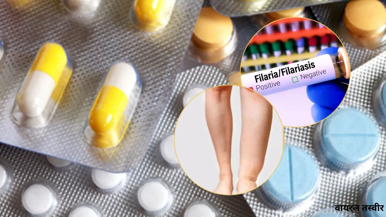 World Lymphedema Day : फाइलेरिया मरीज बने जागरूकता दूत, बीमारी उन्मूलन में निभा रहे अहम भूमिका 