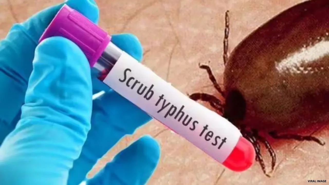 Scrub Typhus Alert: सिर्फ बुखार नहीं, लिवर और किडनी को भी गंभीर नुकसान पहुंचा सकता है स्क्रब टायफस, KGMU-PGI शोध में बड़ा खुलासा
