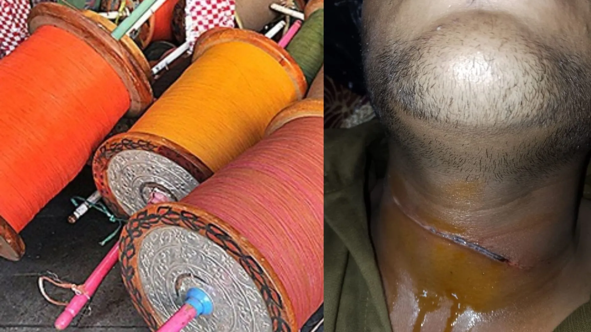 Bareilly News: बरेली में चाइनीज मांझे एक और छात्र की कटी गर्दन, पिछले कुछ दिनों में हो चुकीं कई घटनाएं 