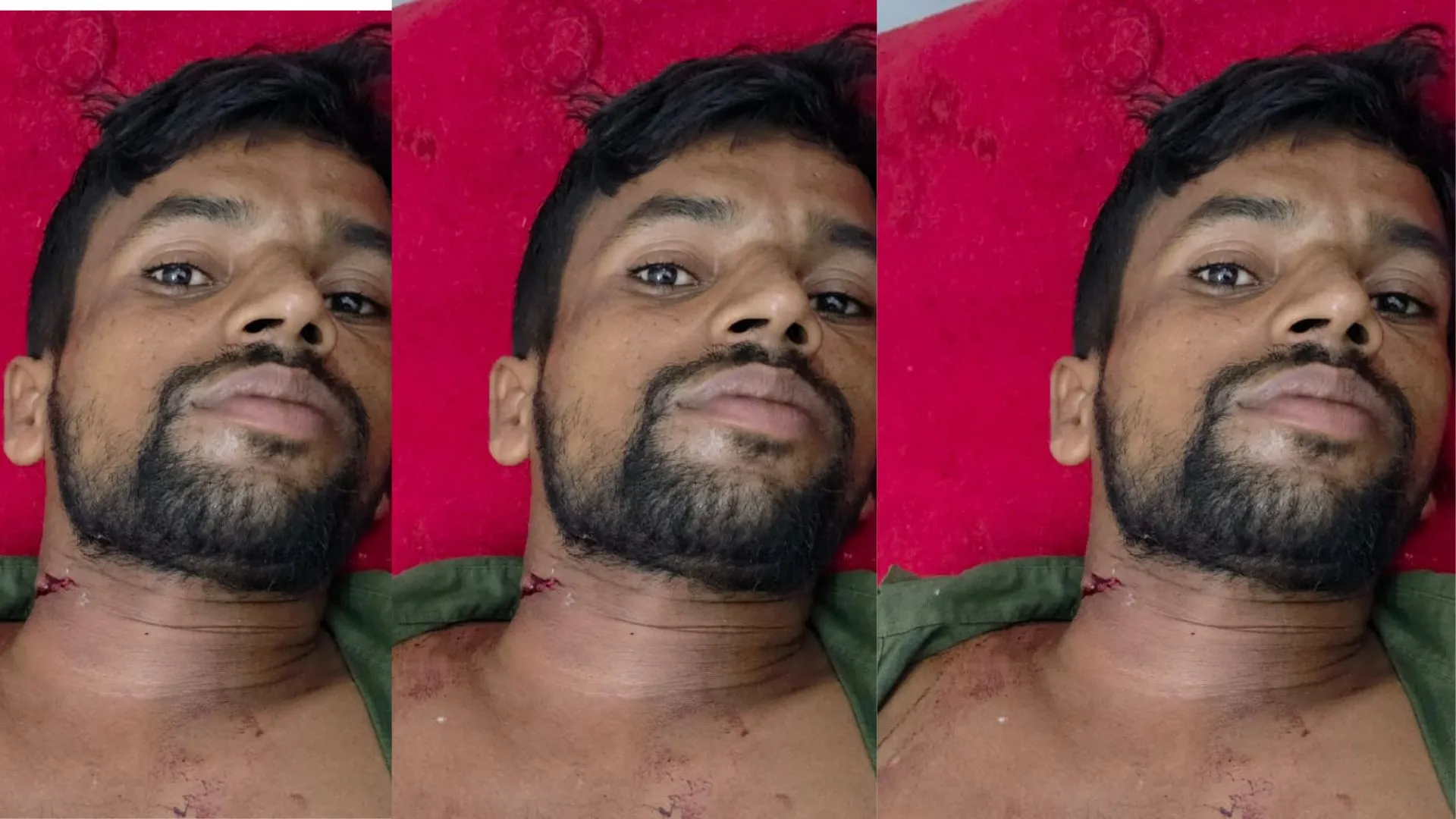 Bareilly News : बरेली में चोरों ने झोंकी फायर, युवक की गर्दन में फंसी गोली, फिर भी दिनभर घूमता रहा घायल 