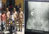 <span class="t-red">Bareilly:</span> शातिर चोर की करतूत...पुलिस ने पकड़ा तो निगल गया चांदी का ब्रेसलेट, कराया गया एक्स-रे