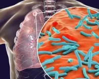 टीबी बीमारी से होने वाली मौतें अब जल्द होंगी कम! नया ‘डिफ्रेंशिएटेड केयर’ मॉडल ला रहा क्रांति