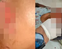 अमेठी : शुकुल बाजार में आवारा कुत्तों के आतंक से ग्रामीणों में दहशत, दो दिनों में 50 लोगों को बनाया निशाना