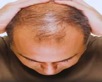 Noida News : शादी के बाद खुला पति के ‘गंजा’ होने का राज, पत्नी ने दर्ज कराया मुकदमा 