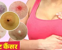 KGMU News: अब स्तन कैंसर की चंद घंटों में हो सकेगी पहचान, केजीएमयू को मिला वियरेबल डिवाइस का पेटेंट 