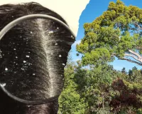 डैंड्रफ, फंगस और त्वचा की समस्या से हैं परेशान तो अपनाए ये जरूरी नुसका, NBRI ने तैयार की दवाई