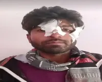 प्रतिबंध के बावजूद बाराबंकी में जारी है चाइनीज मांझे की बिक्री, चपेट में आने से  कटा बाइक सवार का चेहरा