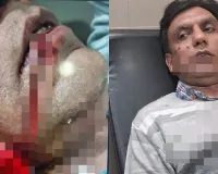 अब चाइनीज मांझे की धार से रिटायर्ड सैन्यकर्मी की चेहरा कटा... राहगीरों ने पहुंचाया अस्पताल, 2017 से प्रतिबंधित है ये मांझा