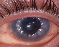 कॉर्नियल दान और प्रत्यारोपण को मजबूत करने के लिए UP में उच्च स्तरीय टास्क फोर्स का गठन 