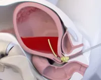 पोस्ट-पार्टम हेमरेज मातृ मृत्यु के प्रमुख कारणों में से एक... देखें क्या बोले एक्सपर्ट