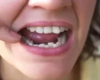 Bareilly : टेढ़े-मेढ़े दांत...सुंदरता ही नहीं कम करते, चबाने और बोलने में भी होती है दिक्कत