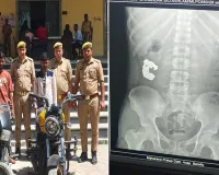Bareilly: शातिर चोर की करतूत...पुलिस ने पकड़ा तो निगल गया चांदी का ब्रेसलेट, कराया गया एक्स-रे