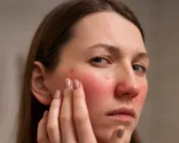 त्वचा के दाग-धब्बे और जोड़ों का दर्द न करें अनदेखा! ल्यूपस और ऑटोइम्यून बीमारियों के संकेत, जानें एक्सपर्ट एडवाइज