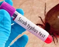 Scrub Typhus Alert: सिर्फ बुखार नहीं, लिवर और किडनी को भी गंभीर नुकसान पहुंचा सकता है स्क्रब टायफस, KGMU-PGI शोध में बड़ा खुलासा