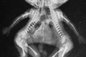 लखीमपुर खीरी में जन्मीं आपस में जुड़ी बच्चियां, परिवार ने मांगी आर्थिक मदद