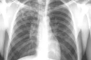 बरेली: जिले में 521 टीबी बाल रोगियों में 62 को संस्थाओं ने लिया गोद