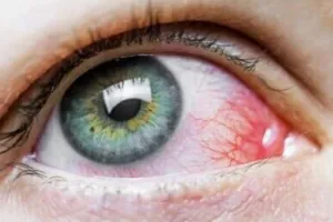 ऋषिकेश: उत्तराखंड में ब्लैक फंगस से पहली मौत, स्वास्थ्य विभाग अलर्ट