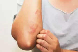 बरसात के मौसम में चर्म रोगों का खतरा ज्यादा, न करें नजरअंदाज