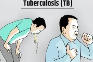 बरेली: आज से घर-घर खोजे जाएंगे क्षय रोगी